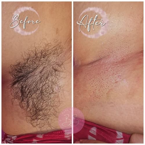 Underarms before and after